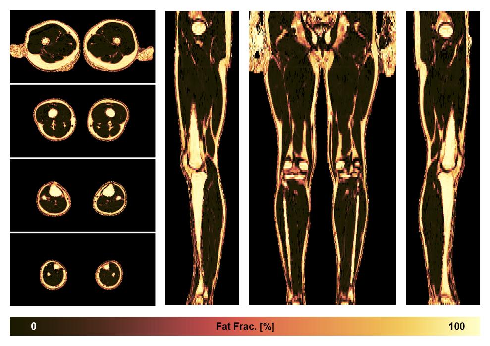 The fat fraction of the lower extremity obtained from the dixon reconstruction for muscle water fat quantification.